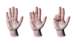 Dupuytren’s Contracture is a condition of the hand in which knots of tissue form under the skin that can pull fingers into a bent position. Contact our office for a consultation with Dr. Garcia to learn of your treatment options.