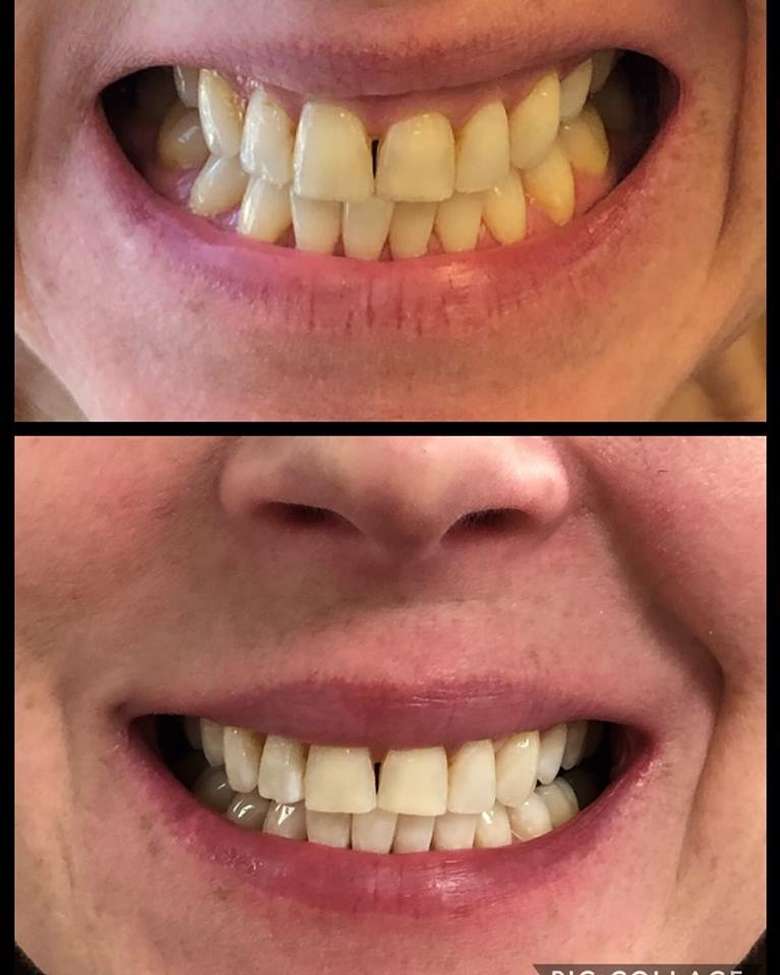 side by side comparison of teeth whitening