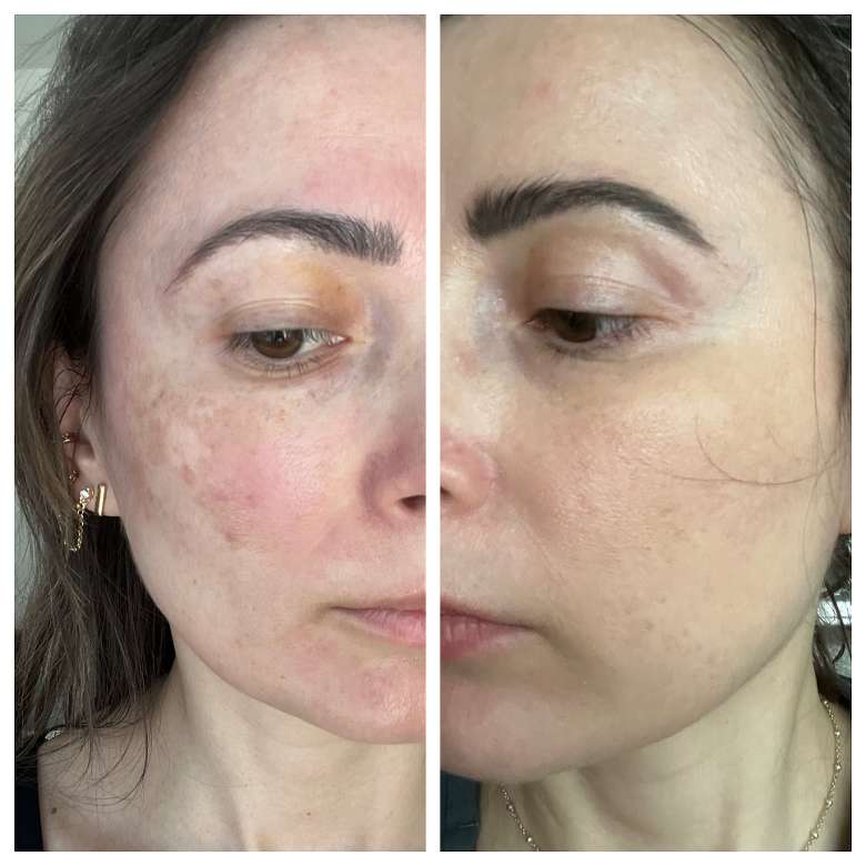 side by side photo of woman after receiving a laser treatment