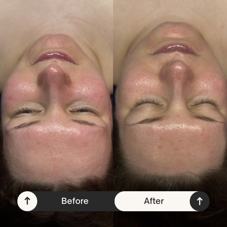 One month apart- this client&rsquo;s skin has a more even skin tone and inflammation has decreased with a personalized home care routine and monthly facials.
