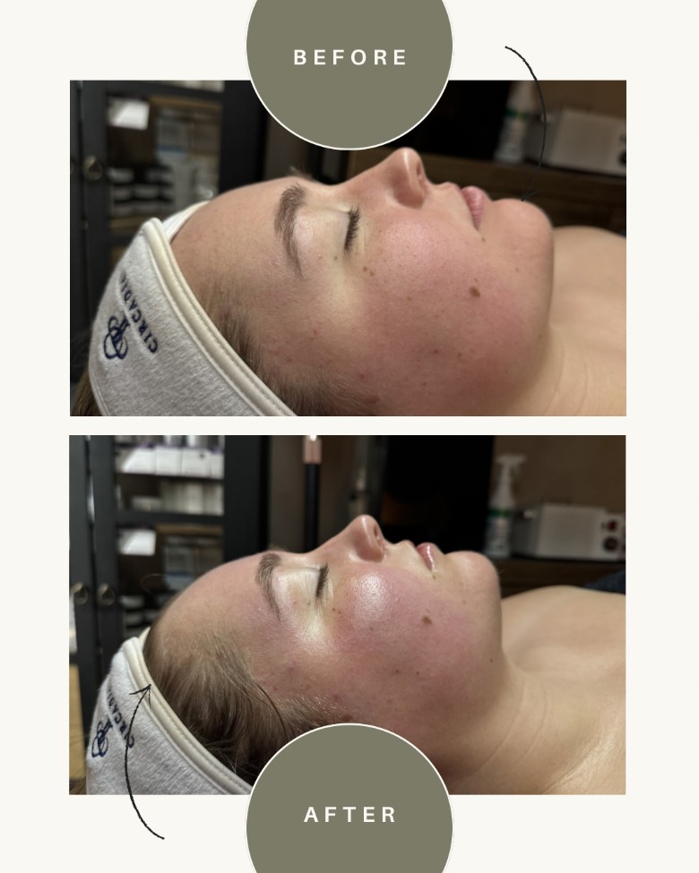 This is a before and after of one facial treatment! The results are amazing.
