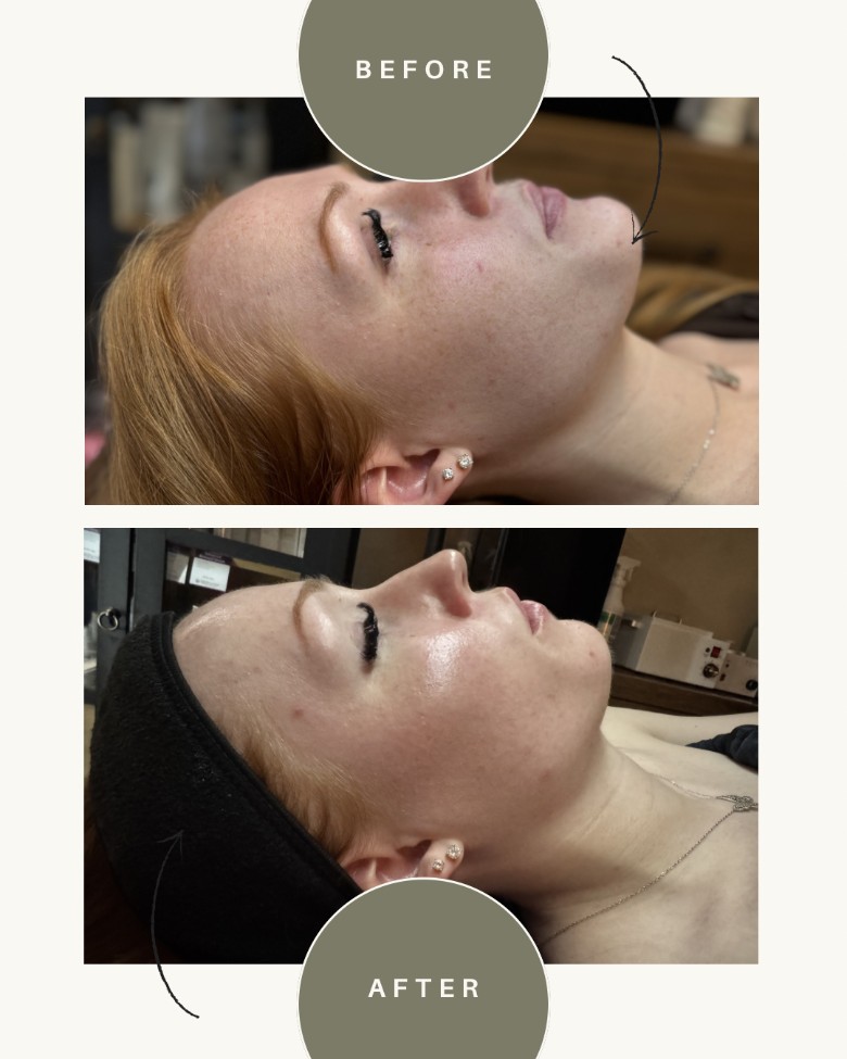 This client is an acne bootcamp client. Her skin is glowing after a chemical peel and one month of personalized home care.
