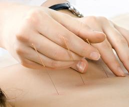 person performing acupuncture