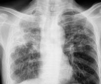 tuberculosis lungs chest x-ray