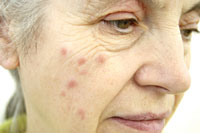 old woman face rash