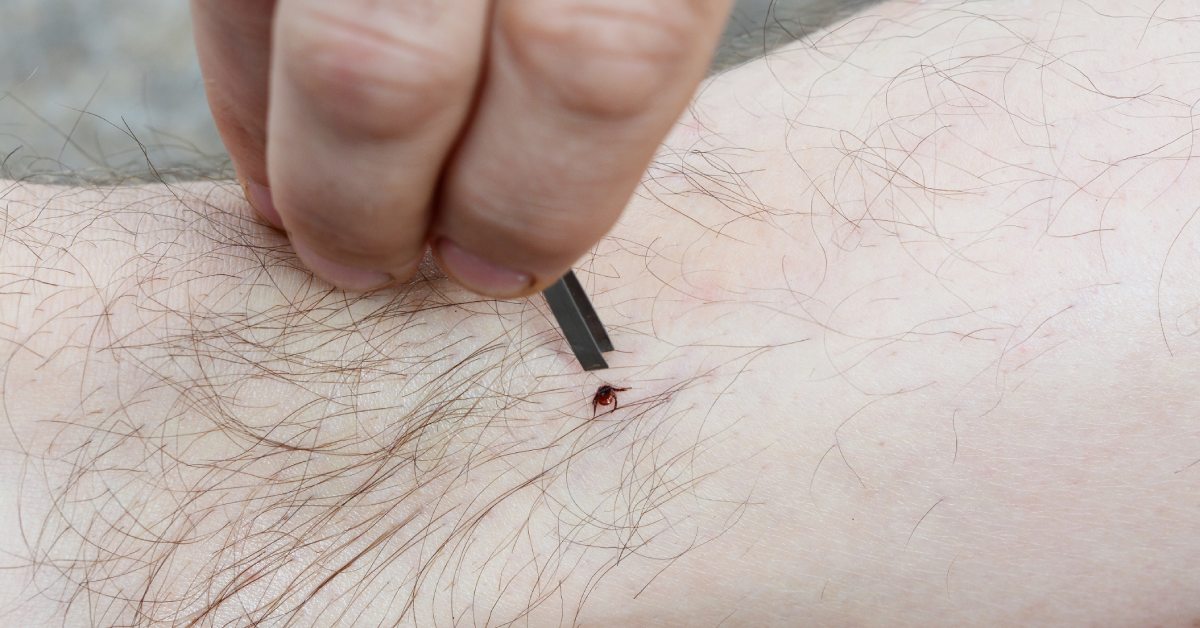 tick being removed from arm with tweezers