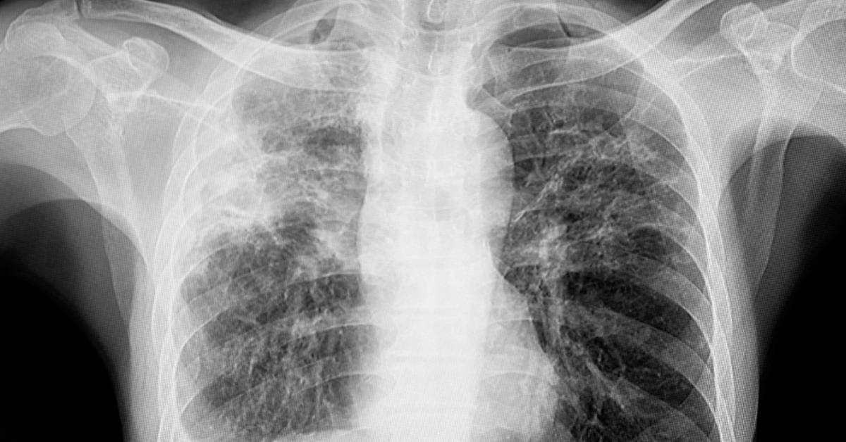chest x ray of lungs with tuberculosis